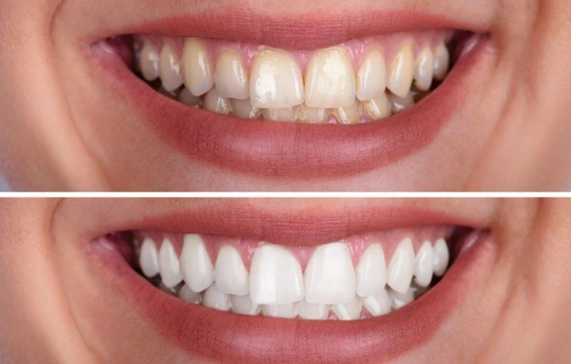 Comparação do sorriso antes e depois do clareamento dental