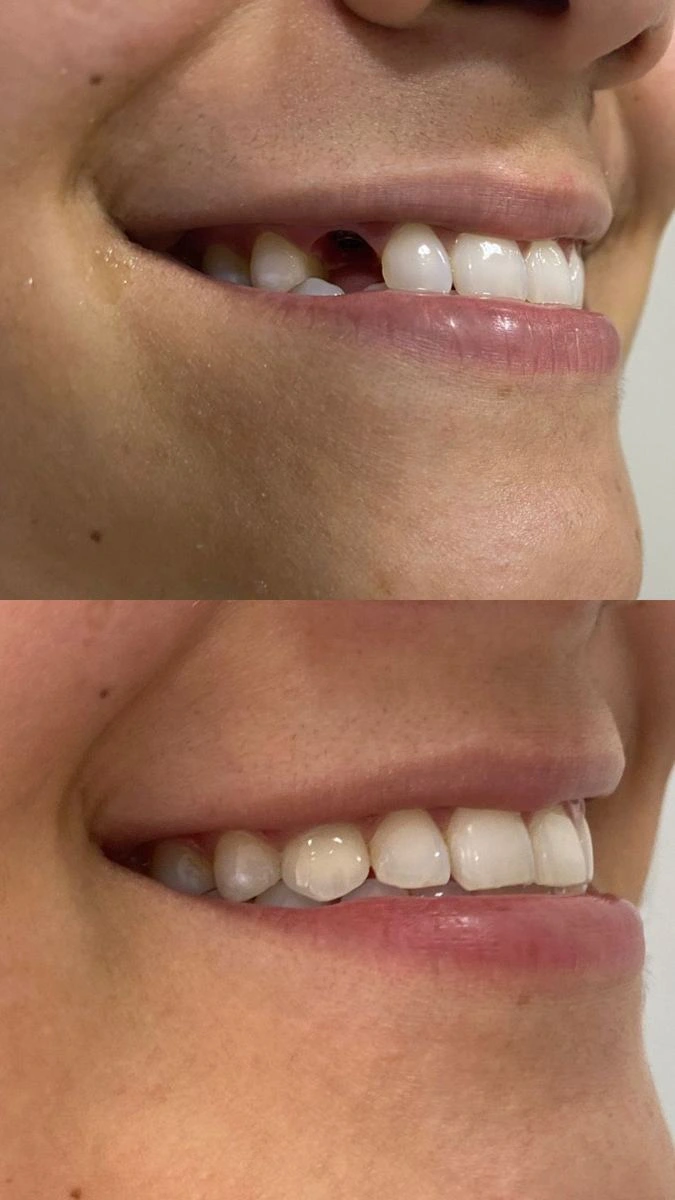 Comparação do sorriso antes e depois do implante unitário